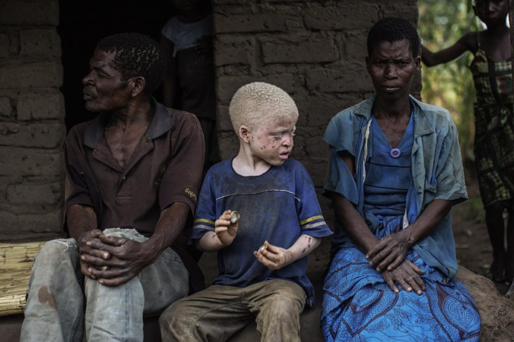 Boy with albinism sitting down